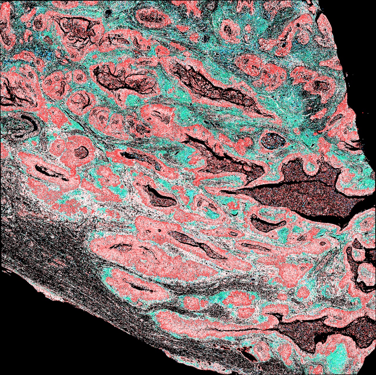 Spatial cell classification of cervical tissue produced by MiraTyper
