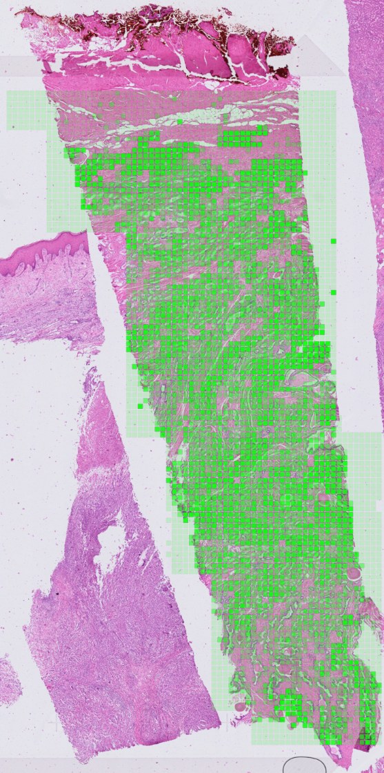 PSMA RNA expression measured by Xenium on the same section